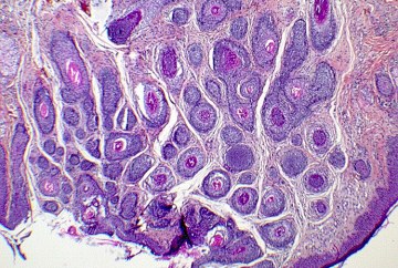 Diagnostic médical au microscope